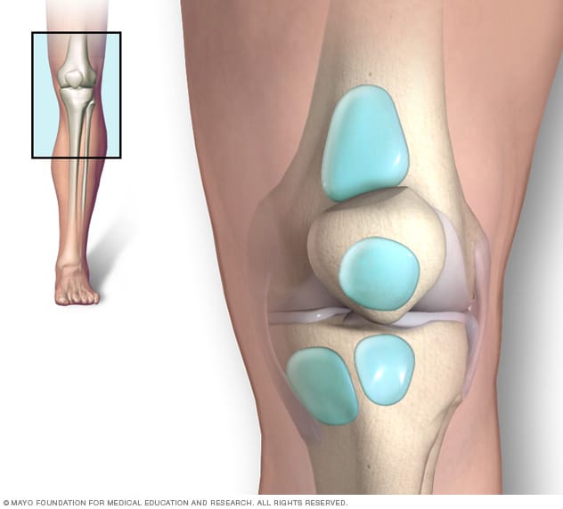 könyök ízületi vérzéses bursitis)