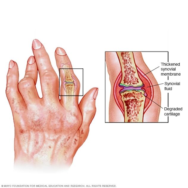 rheumatoid arthritis)
