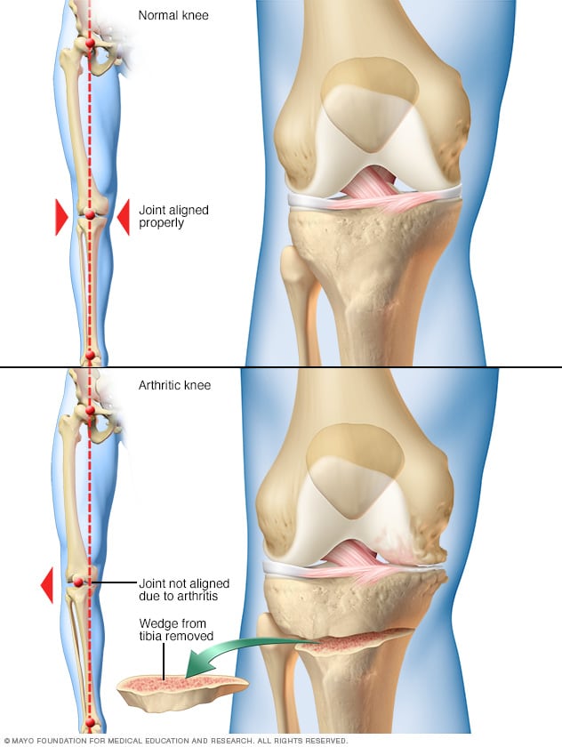 osteoarthritis treatment)