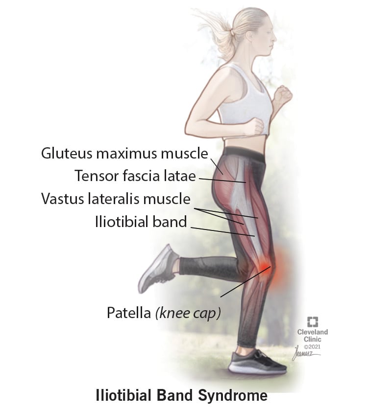 iliotibial tract pain)