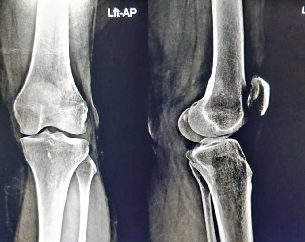 a boka kezelésének deformált osteoarthritis)