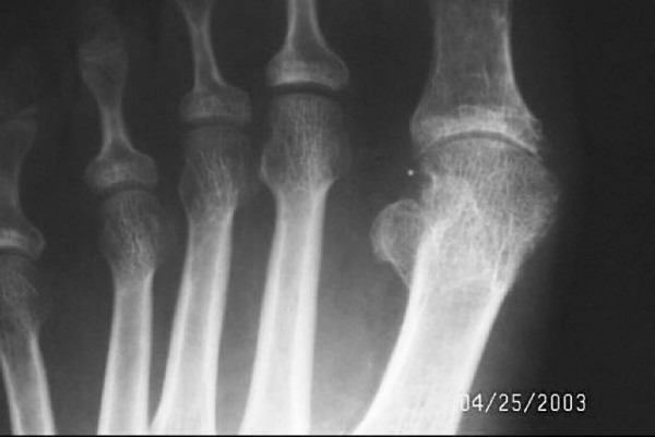 metatarsophalangealis osteoarthritis