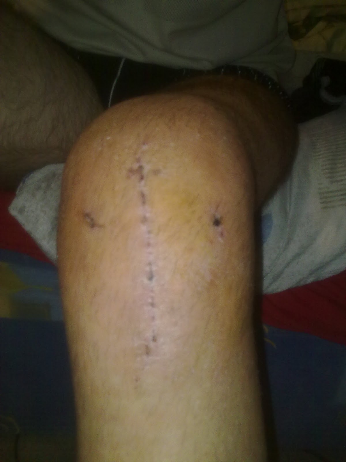 Keresztszalag szakadás rehabilitációja