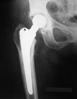 Csípőfájdalom fiatal korban Az osteoarthritis tünetei