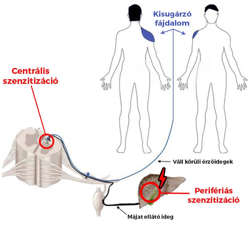 Ez tipikusan éjjeli vállfájdalmat okozhat