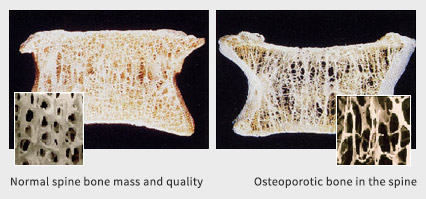 térd osteoporosis)