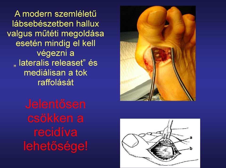 a láb metatarsalis osteoarthritisének kezelése