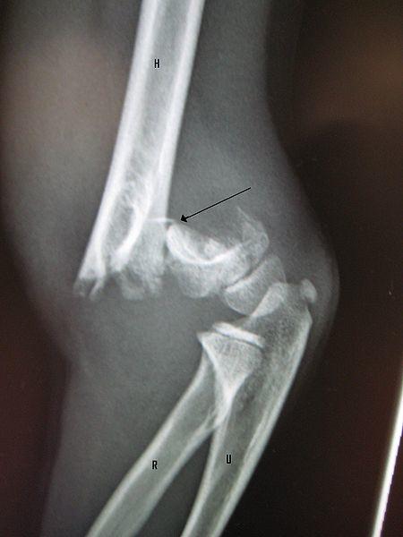 Építőanyagok Beton: Humerus proximalis végének törése gyógytorna