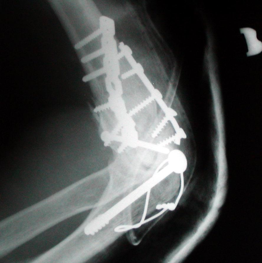humerus proximalis végének törése gyógytorna