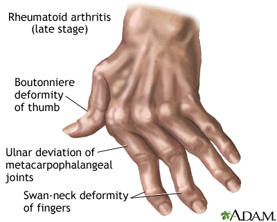 rheumatoid arthritis)