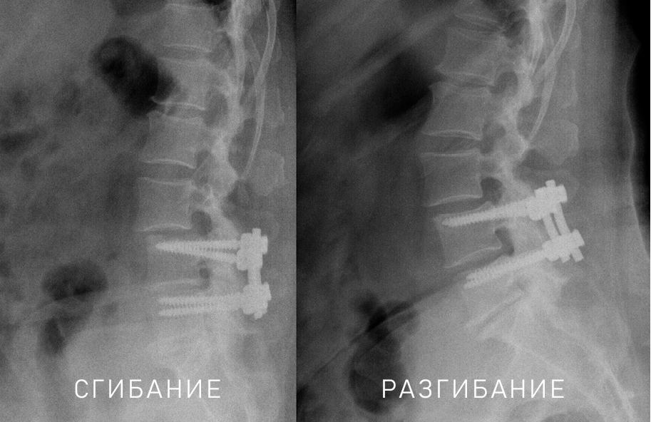 osteochondrosis l4)