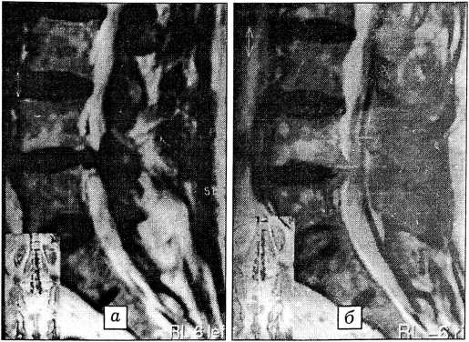 osteochondrosis l4