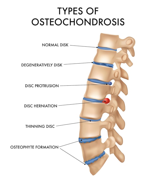 osteochondrosis spine treatment