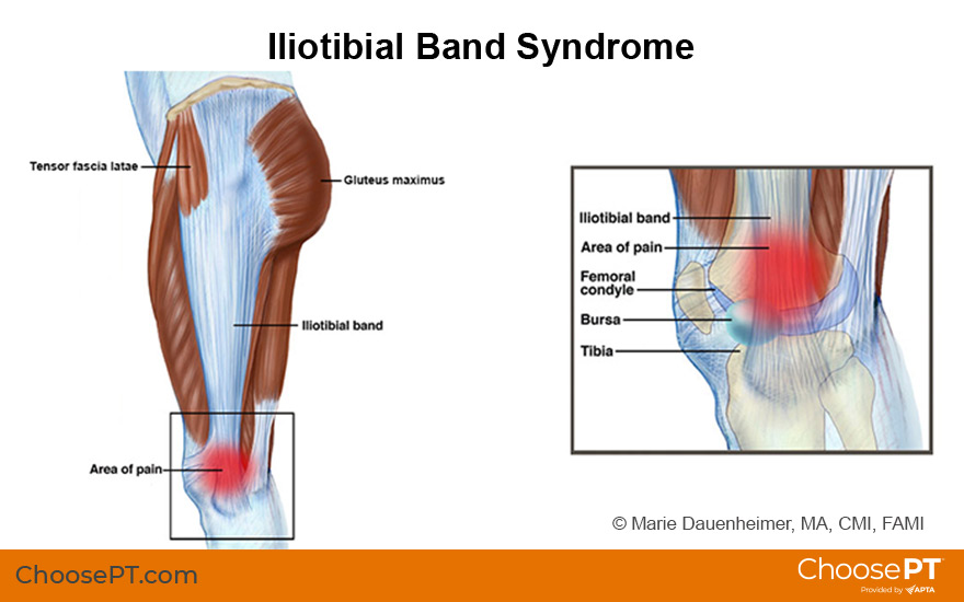iliotibial tract pain)