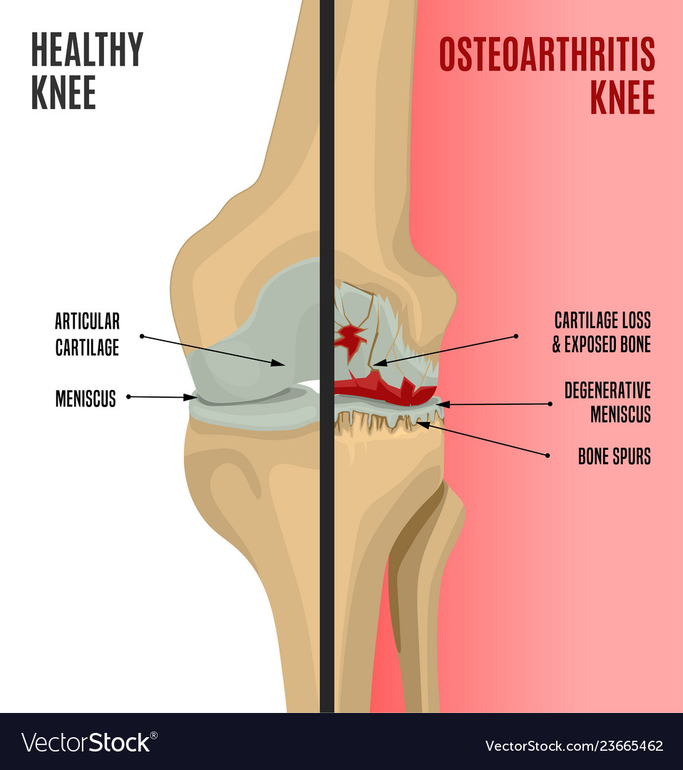 1 fokú boka osteoarthritis kezelése