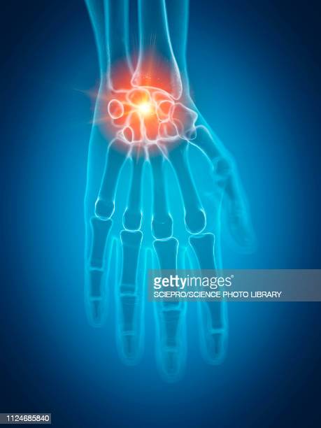 carpal carpal 1 ujja