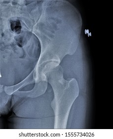 coxarthrosis gonarthrosis artroxis kis ízületek