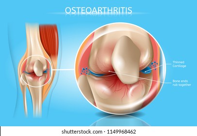 ízületi sérülések és osteoarthritis)