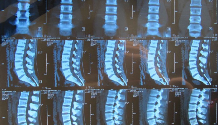 kenőcsillag csillag nyaki osteochondrozissal)