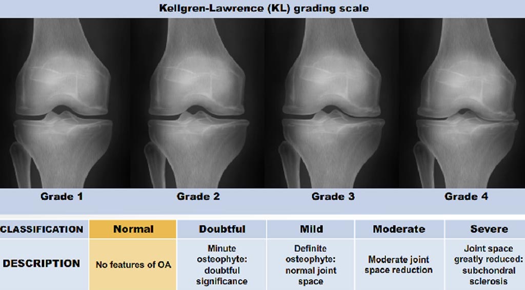 innovatív kezelések az osteoarthritis kezelésére)