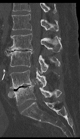 osteochondrosis s1