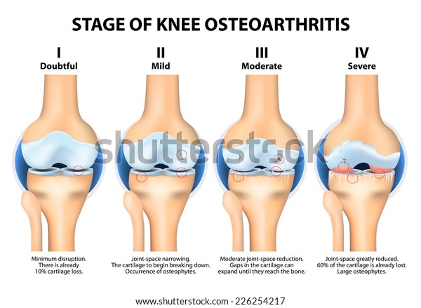 térd osteoarthrosis kezelése kenőcsökkel)