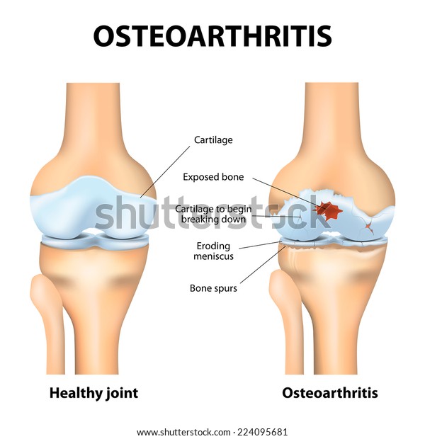 artrózis és térd osteoarthrosis