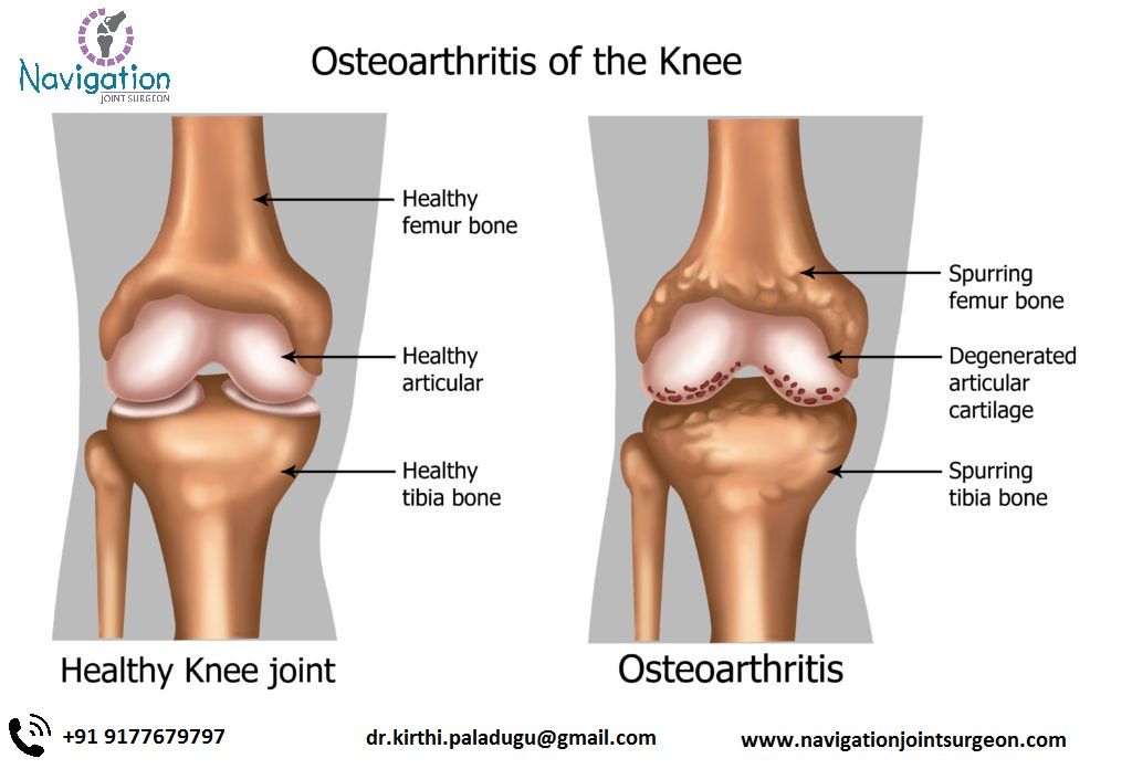 milyen fokú osteoarthritis a térd)