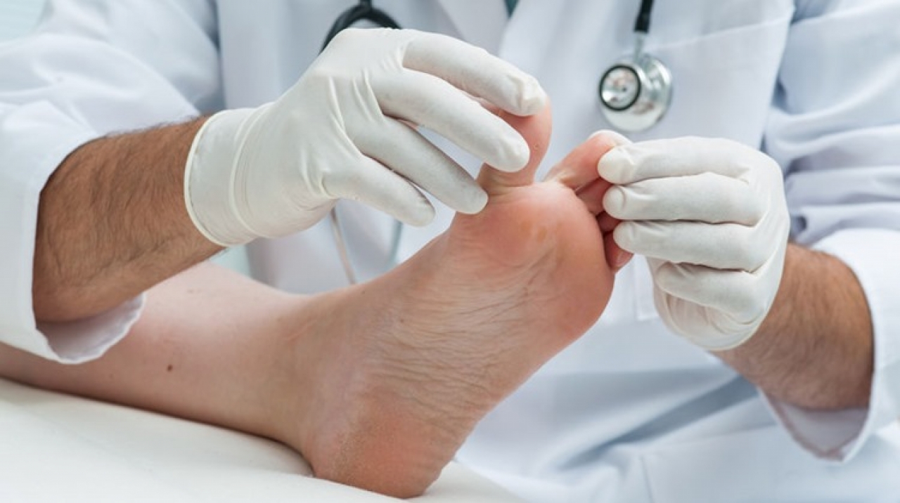 Rheumatoid arthritis