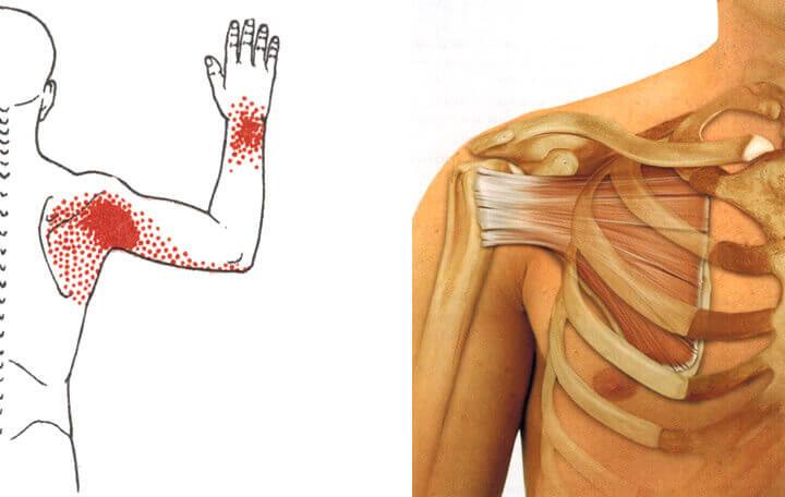 gyulladásgátló szer nyaki osteochondrozishoz