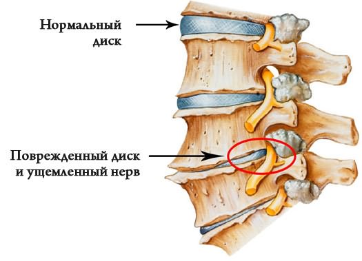 deformáló csípőízületek osteoarthrosis kezelése)