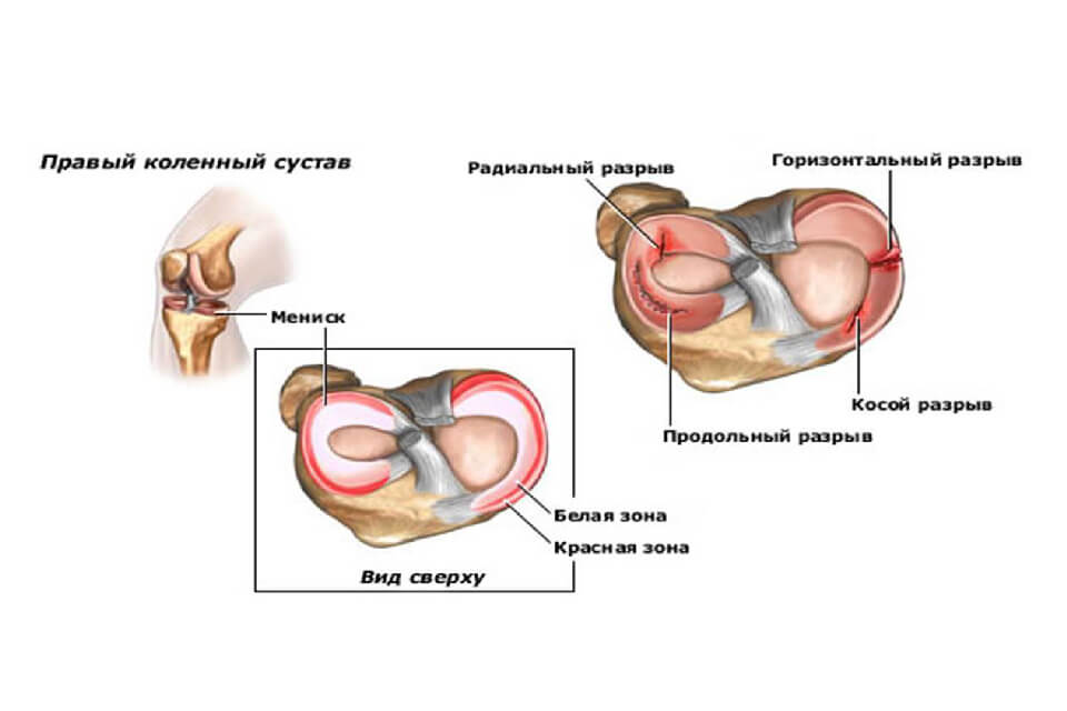 Az arthrosis népi gyógymódok otthoni kezelése - Csukló July Ízületi hellebore kezelés