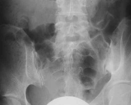 Csípőízület coxarthrosis 2 fokos kezelési módszerei