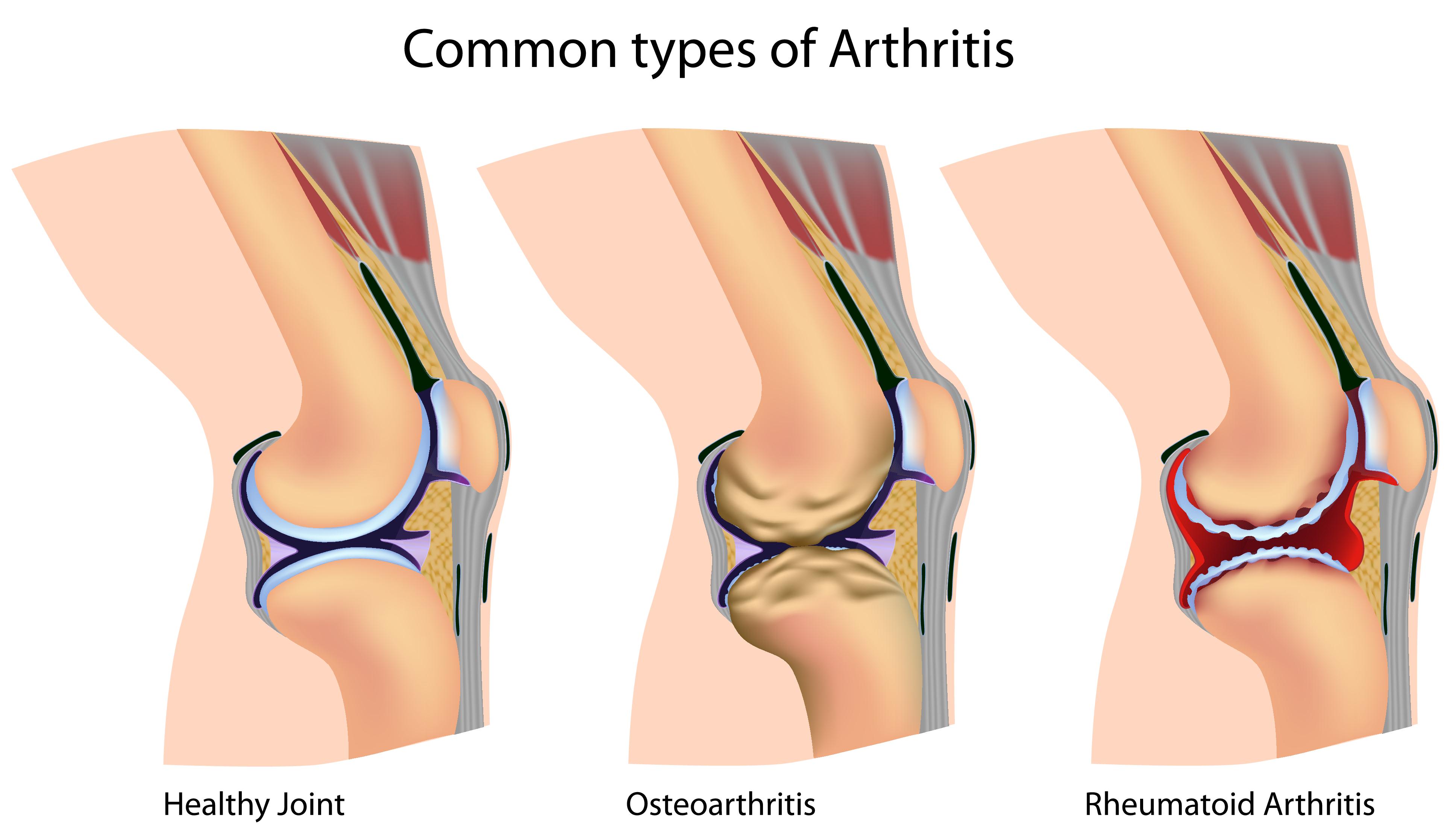 hogyan kezeljük a sarok rheumatoid arthritisét
