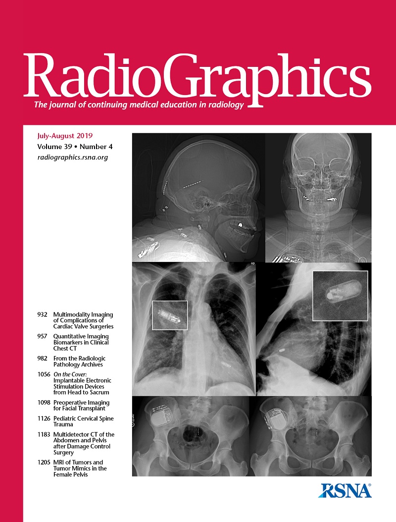 Gyulladásgátló kenőcsök gélei az oszteokondrozishoz, A nyaki osteochondrosis okai