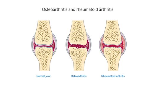 Rheumatoid arthritis early stages., Rheumatoid arthritis early stages
