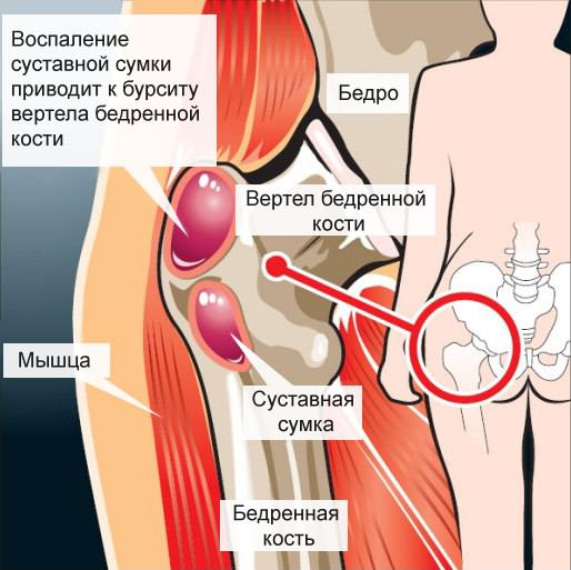 a boka ízületének deformáló osteoarthrosis kezelése