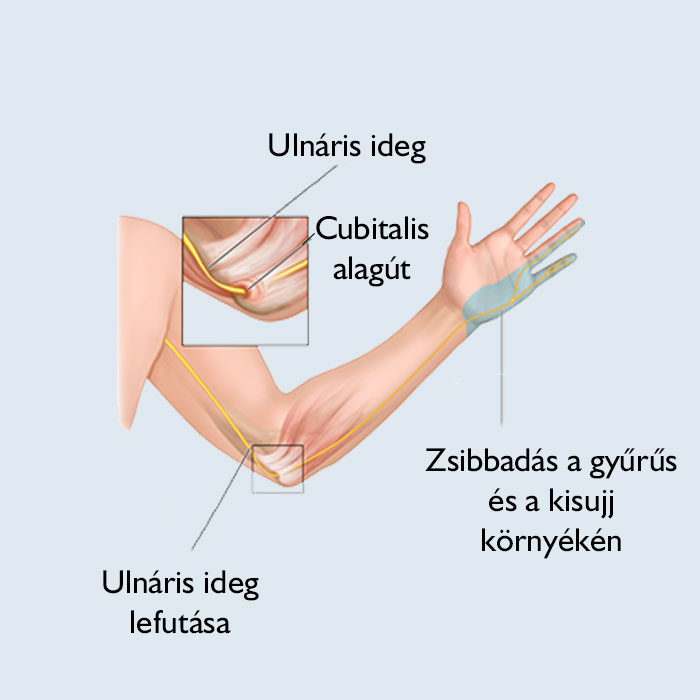 Ujjgyűrű ízületi fájdalom