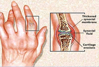 TORNAGYAKORLATOK RHEUMATOID ARTRITIS ESETÉN