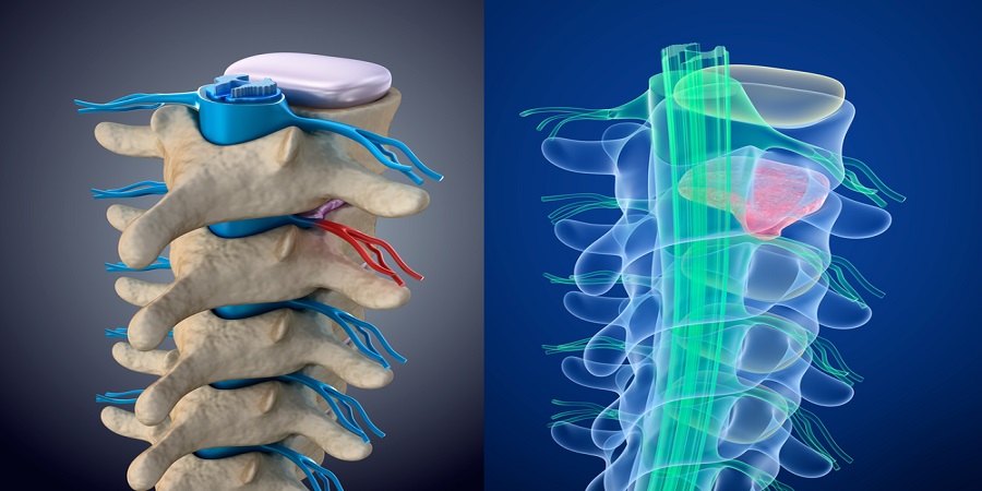 Sacroileitis – a csípő-keresztcsonti ízület gyulladása