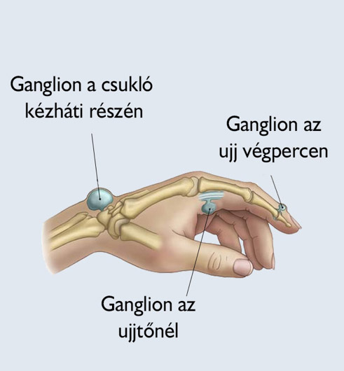 az ízületi gyógyszerből)