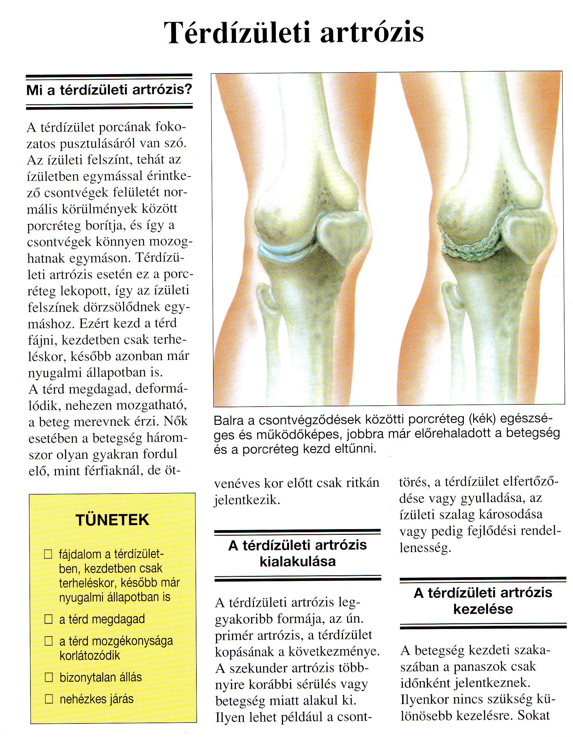 Metatarsalis arthrosis és kezelés, Ízületi porckopás (artrózis) - Tünetek és okok