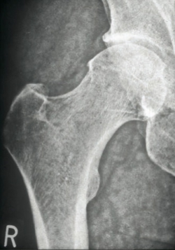 coxarthrosis a csípőízület 3 fokos kezelése