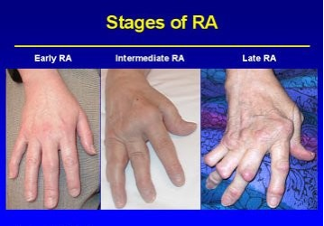 rheumatoid arthritis early stages