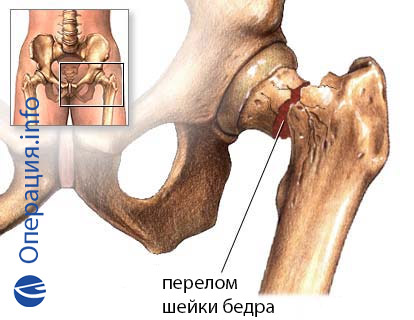 deformáló artrosis a láb hogyan kell kezelni ízületek ízületi gyulladása és kezelése