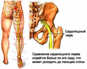 Könyökízület ízületi gyulladása hogyan lehet enyhíteni a fájdalmat. Ízületi kopás és gyulladás