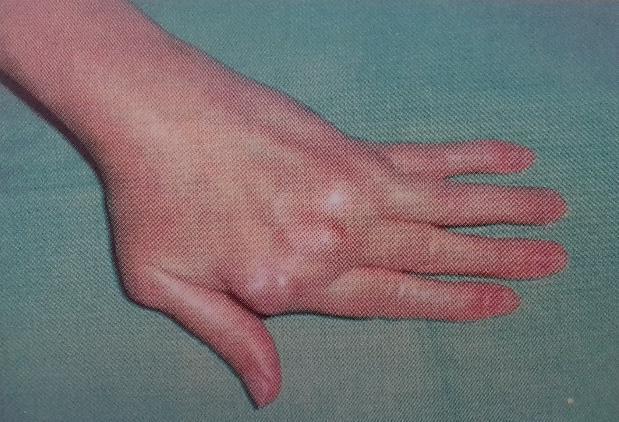 Rheumatoid arthritis kezelés természetes módon