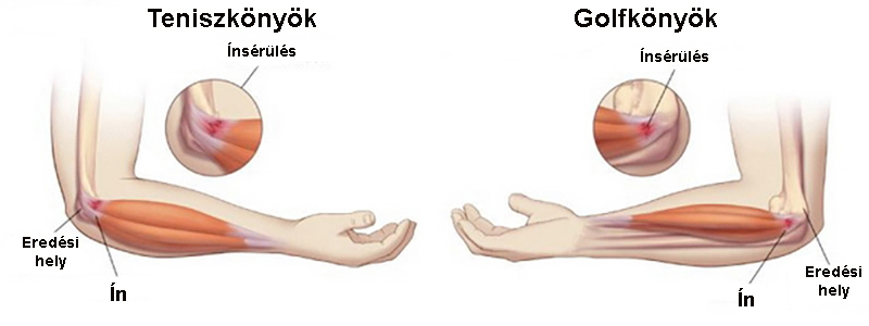 fájó kar a vállízületben és alatt