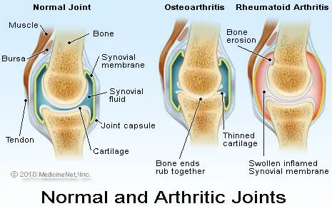 rheumatoid arthritis és osteoarthritis