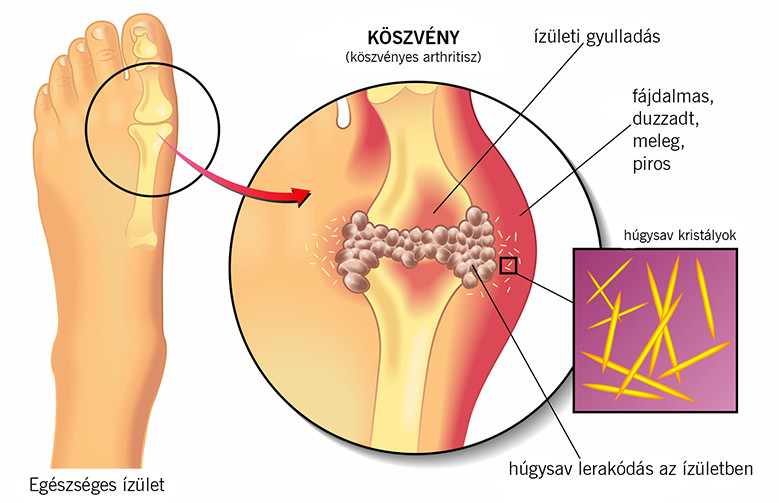 ín ízületi kezelés)